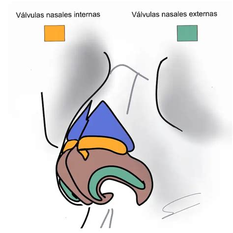 Diagrama de la anatomía nasal mostrando la válvula nasal y posibles colapsos