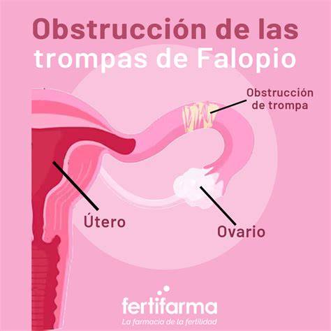 Ilustración de la anatomía de las trompas de Falopio antes y después de una ligadura, y un esquema de cómo se reconectan en una recanalización tubárica.
