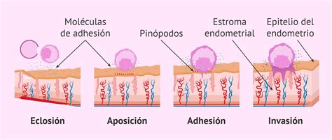 Diagrama del blastocisto implantándose en el endometrio uterino
