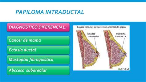 Infografía sobre la diferenciación histológica entre el papiloma intraductal y el carcinoma papilar mediante marcadores de células mioepiteliales.