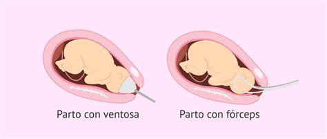 Esquema: Uso de ventosa obstétrica durante el parto