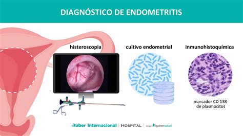 Micrografía: Endometrio saludable vs. endometrio con endometritis