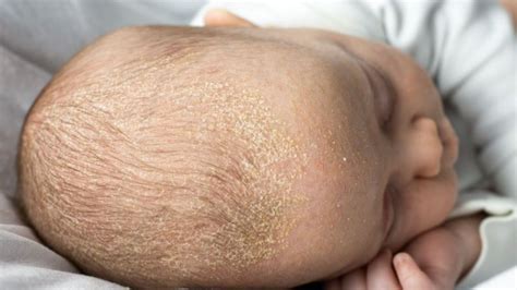 Primer plano de la costra láctea en el cuero cabelludo de un bebé.