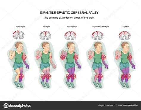 imagen de un niño con parálisis cerebral espástica mostrando rigidez muscular