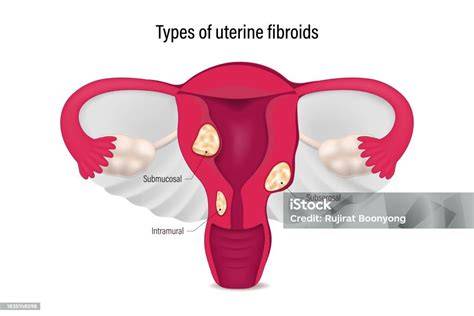 Diagrama anatómico mostrando la ubicación de fibromas, pólipos y obstrucciones en las trompas de Falopio.