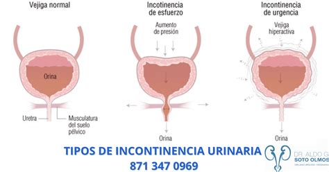 Ilustración esquemática de los diferentes tipos de incontinencia urinaria.