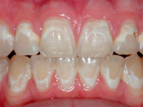 Foto: Dientes de bebé con manchas blancas y marrones por caries del biberón