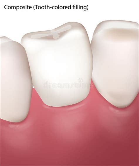 Ilustración: Proceso de relleno dental en un niño