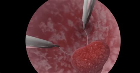 imagen de un pólipo uterino y cómo se extirpa durante una histeroscopia