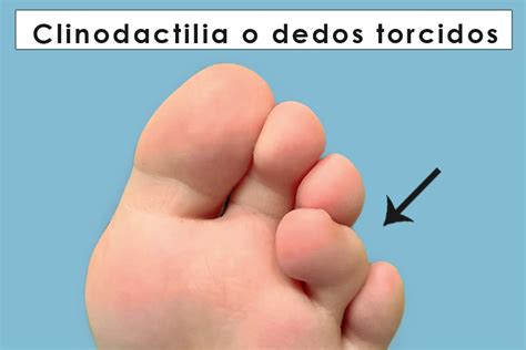 Representación anatómica de un pie con clinodactilia en el quinto dedo