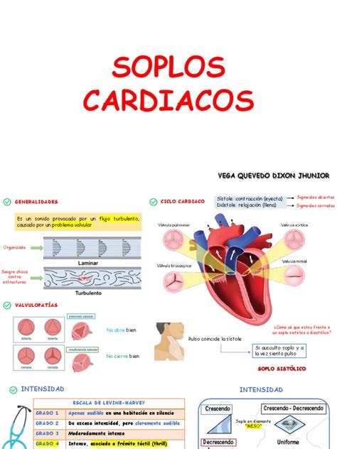 Infografía sobre los mecanismos de formación de los soplos cardíacos por flujo turbulento