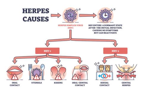 Esquema de las vías de transmisión del virus del herpes simple al recién nacido