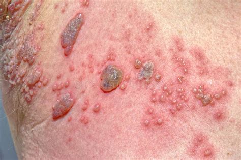 Imagen de lesiones cutáneas (ampollas) en un recién nacido por infección de herpes