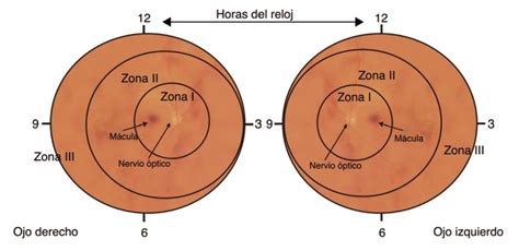 Representación de las zonas de la retina afectadas por ROP y la importancia de la clasificación ICROP.