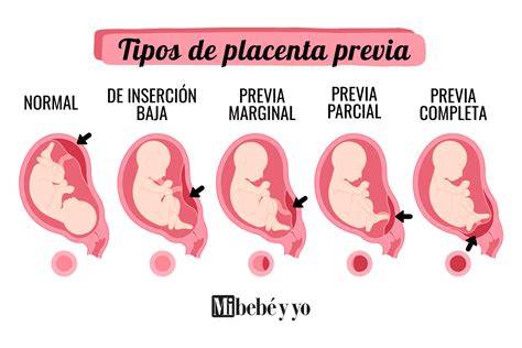 Ilustración de los diferentes tipos de placenta previa: baja, marginal, parcial y total