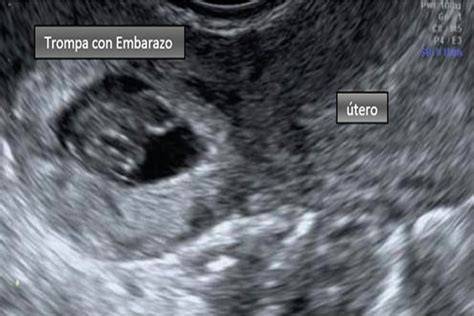 Ecografía de un embarazo ectópico tubárico