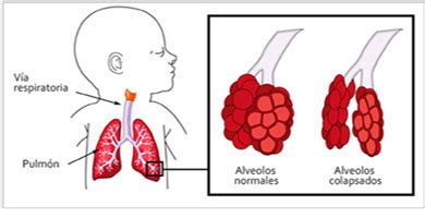 Esquema de pulmones inmaduros y alvéolos con deficiencia de surfactante