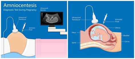 diagrama del procedimiento de amniocentesis bajo guía ecográfica