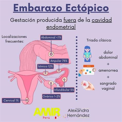 Esquema de las diferentes localizaciones de un embarazo ectópico