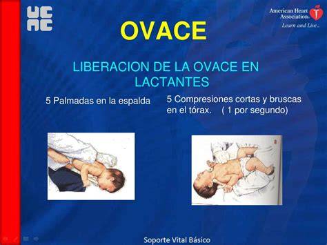 ilustracion de maniobra de OVACE en lactantes