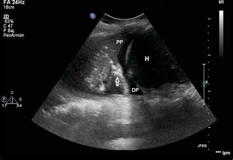 Ecografía pulmonar mostrando consolidación con broncograma aéreo hiperecoico