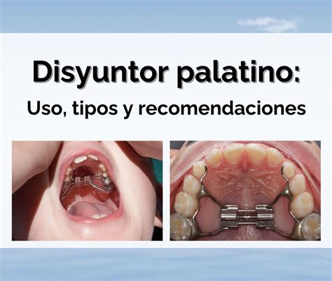Diagrama de un disyuntor palatino