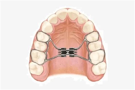 Comparación de diferentes tipos de disyuntores dentales (Hyrax, Hass, McNamara)