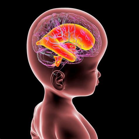 ilustración médica que muestra el cerebro de un bebé moviéndose dentro del cráneo durante el zarandeo