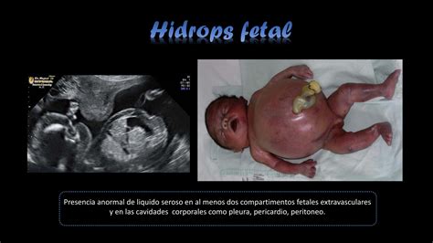 Ecografía fetal que muestra signos de hidrops fetalis, como acumulación de líquido.