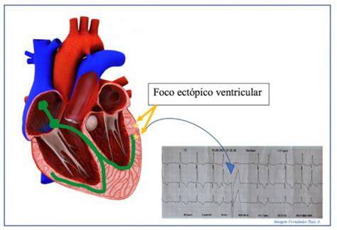 Esquema de un foco ectópico en la aurícula generando una taquicardia