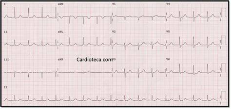 Electrocardiograma de 12 derivaciones mostrando taquicardia auricular con ondas P anómalas