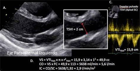 Ecocardiografía Doppler en modo M mostrando ventrículo izquierdo dilatado antes del tratamiento