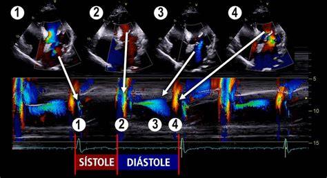 Ecocardiografía Doppler en modo M mostrando la disminución del tamaño del ventrículo izquierdo y recuperación de la función sistólica tras el tratamiento