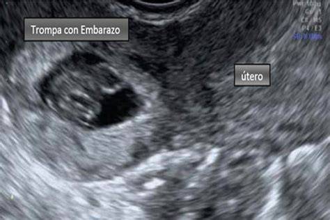 Ecografía transvaginal mostrando un embarazo ectópico en la trompa de Falopio