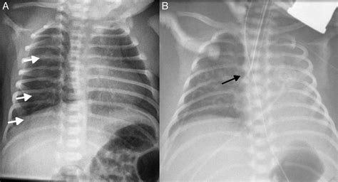 Radiografía de tórax de un recién nacido con Síndrome de Dificultad Respiratoria mostrando el patrón típico de 