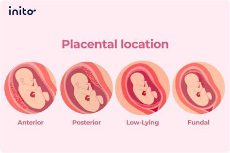 Infografía comparativa: placenta anterior, posterior y fúndica