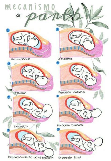 Ilustración médica que muestra el mecanismo de atrapamiento de una extremidad fetal por una banda amniótica.