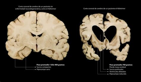 Infografía comparativa de un cerebro sano frente a uno con síndrome alcohólico fetal, resaltando el cuerpo calloso y el tamaño cortical