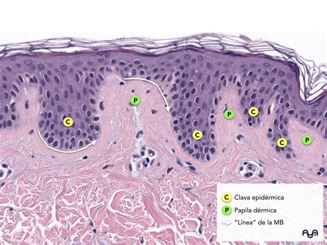 Microfotografía mostrando el depósito de IgA en la unión dermoepidérmica, criterio diagnóstico fundamental