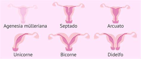 Esquema que muestra la clasificación de las malformaciones uterinas (útero septo, bicorne, didelfo, etc.) y su impacto en la cavidad endometrial.