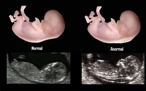 Esquema anatómico que muestra la medición de la translucencia nucal en un feto, señalando el espacio sonolucente entre la piel y el tejido subcutáneo de la nuca.