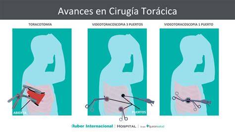Esquema de las incisiones torácicas en una cirugía pediátrica mínimamente invasiva