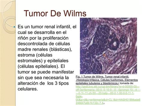 Micrografía de células de tumor de Wilms
