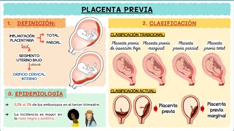 Diagrama de la placenta previa y sus diferentes clasificaciones