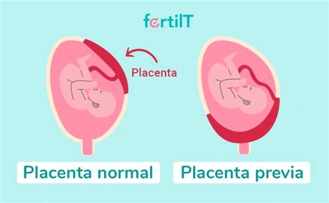 Esquema médico que muestra la diferencia entre una placenta en posición normal y una placenta previa total oclusiva.