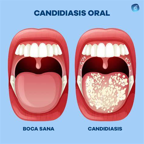 Diagrama de boca con caries o infección por Candida albicans