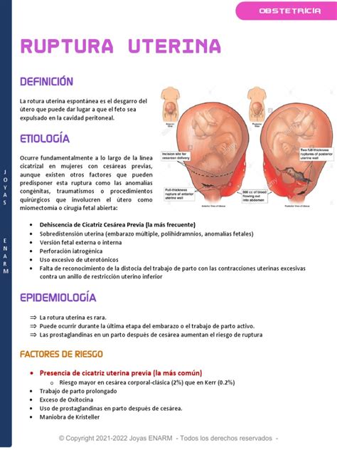 Diagrama comparativo: ruptura de fuente vs. parto velado.