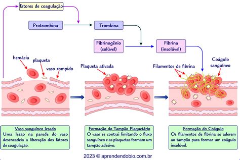 representación esquemática de la formación de un coágulo sanguíneo y su posible desprendimiento hacia los pulmones