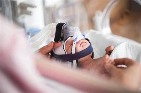 Esquema de un bebé prematuro usando CPAP nasal con mascarilla