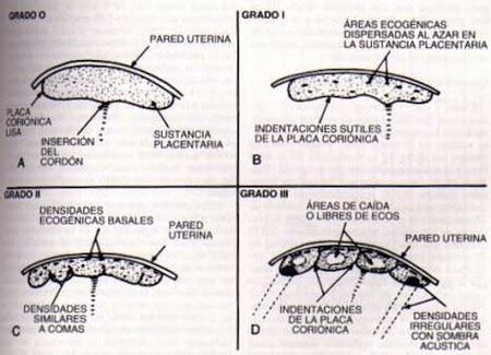 Representación ecográfica de los diferentes grados de madurez placentaria.